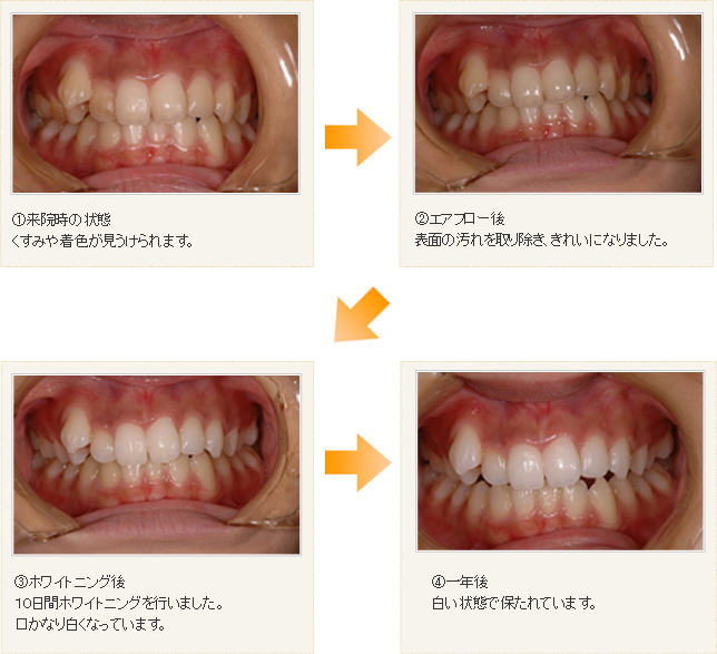 ホワイトニング
